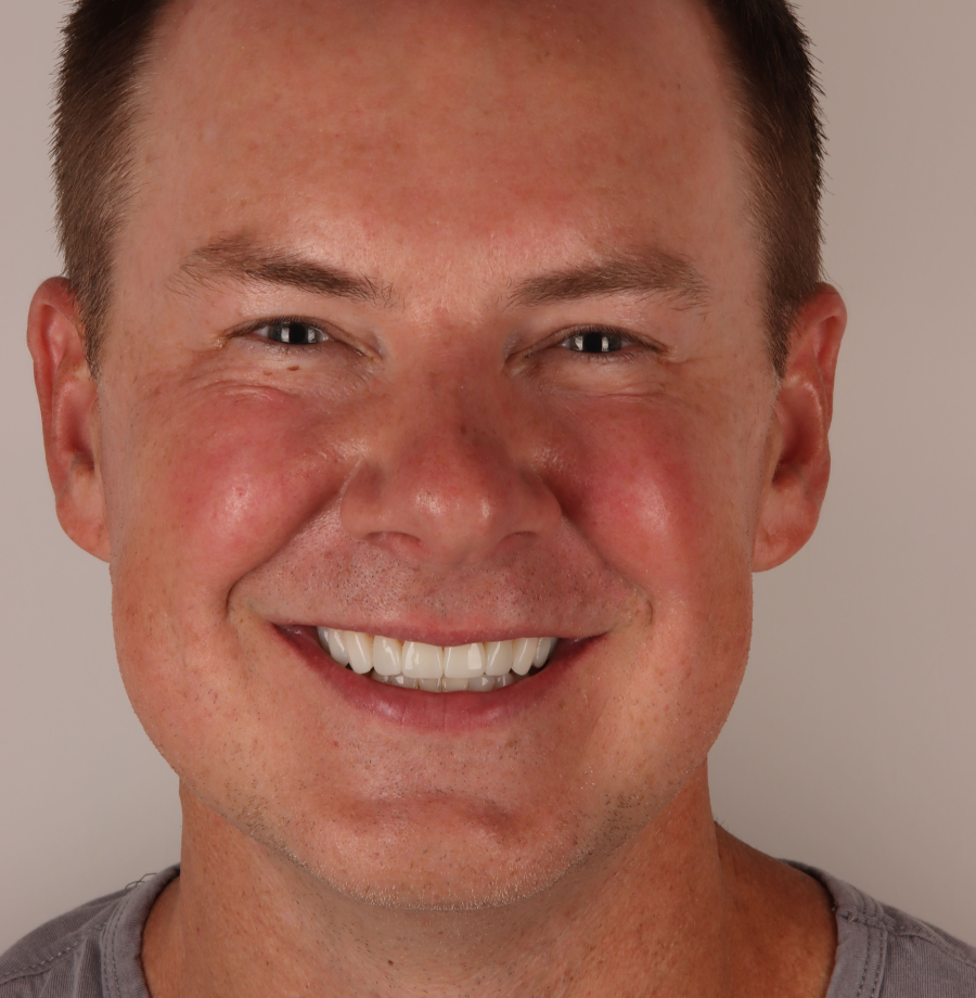 Alex after Noplamina veneers