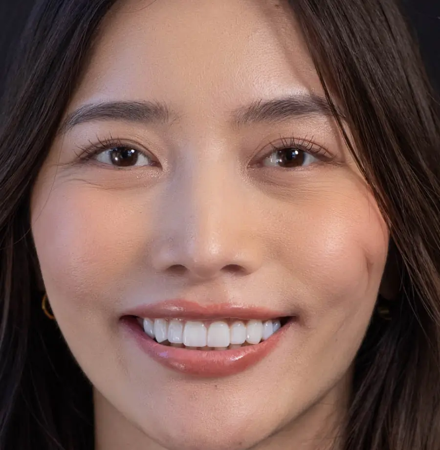 Arisa after Noplamina veneers