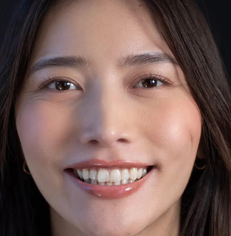 Arisa before Noplamina veneers