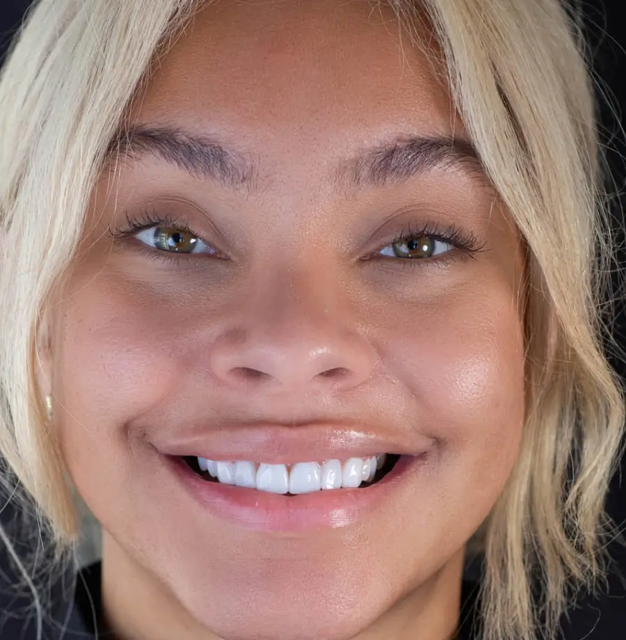 Mia after Noplamina veneers