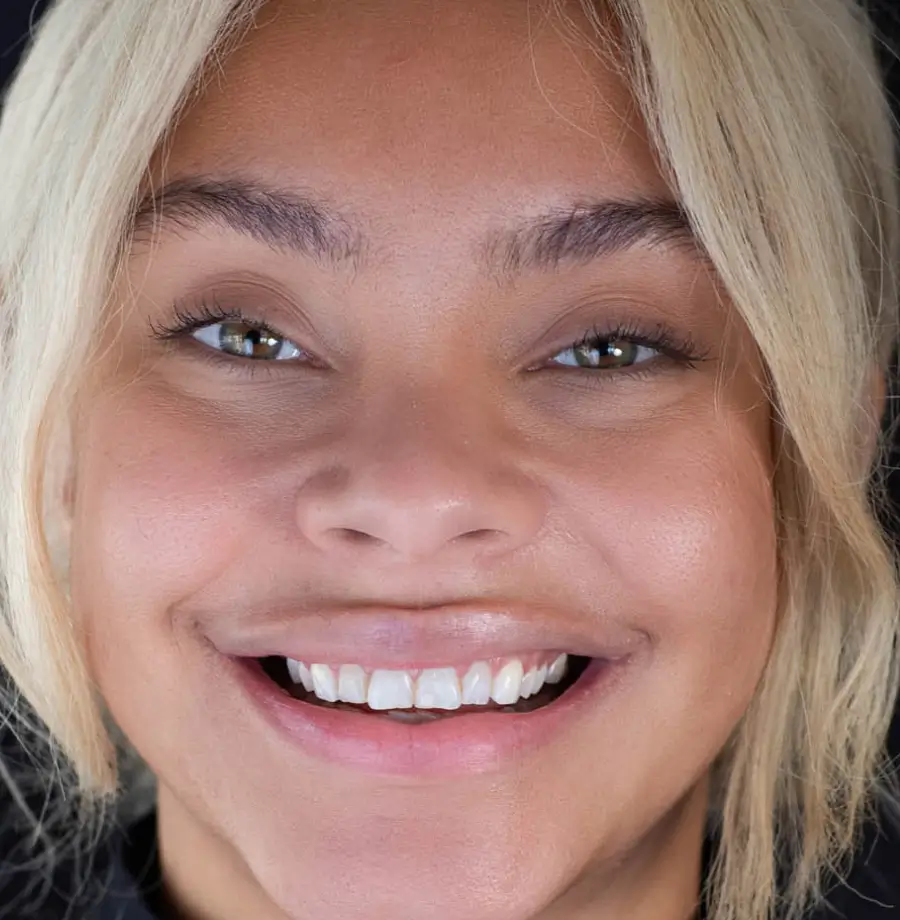 Mia before Noplamina veneers